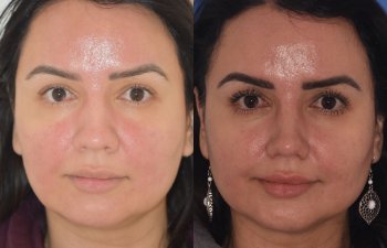 patient before and after rhinoplasty