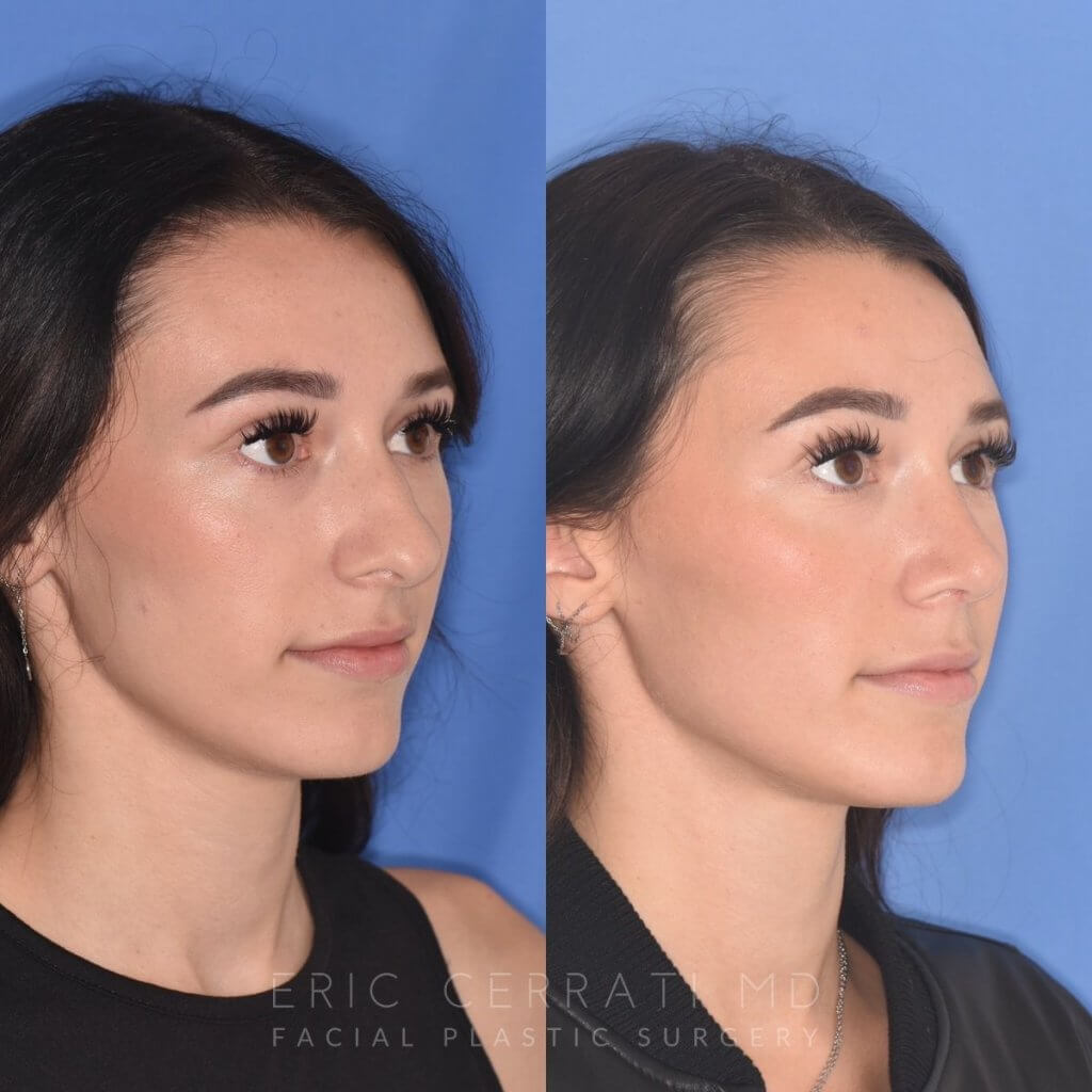 patient before and after rhinoplasty procedure