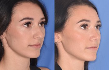 patient before and after rhinoplasty procedure