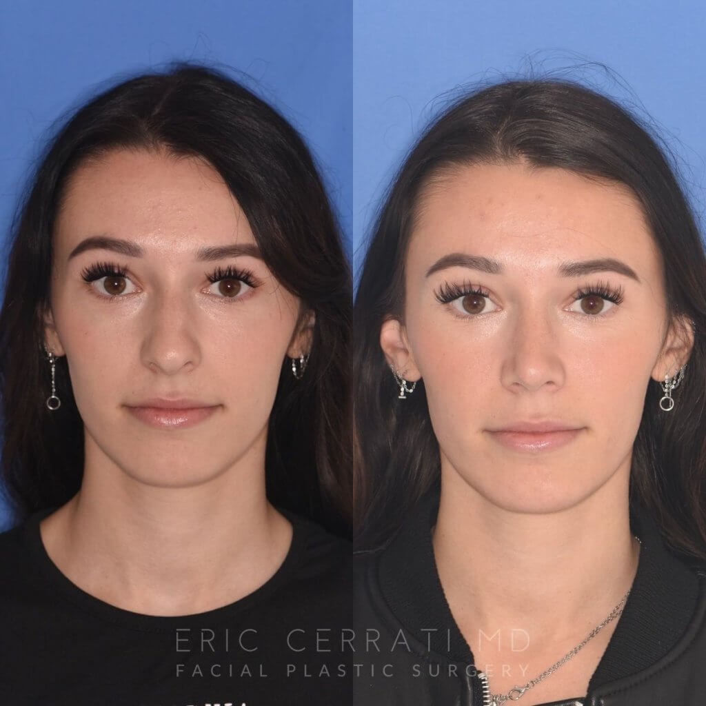 patient before and after rhinoplasty procedure