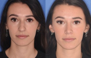 patient before and after rhinoplasty procedure