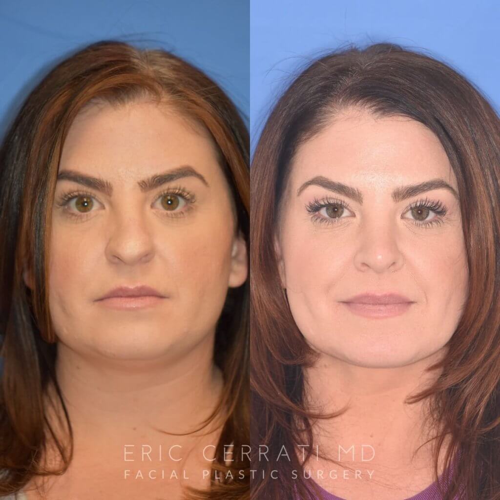 patient before and after rhinoplasty