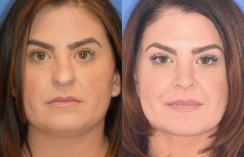 patient before and after rhinoplasty