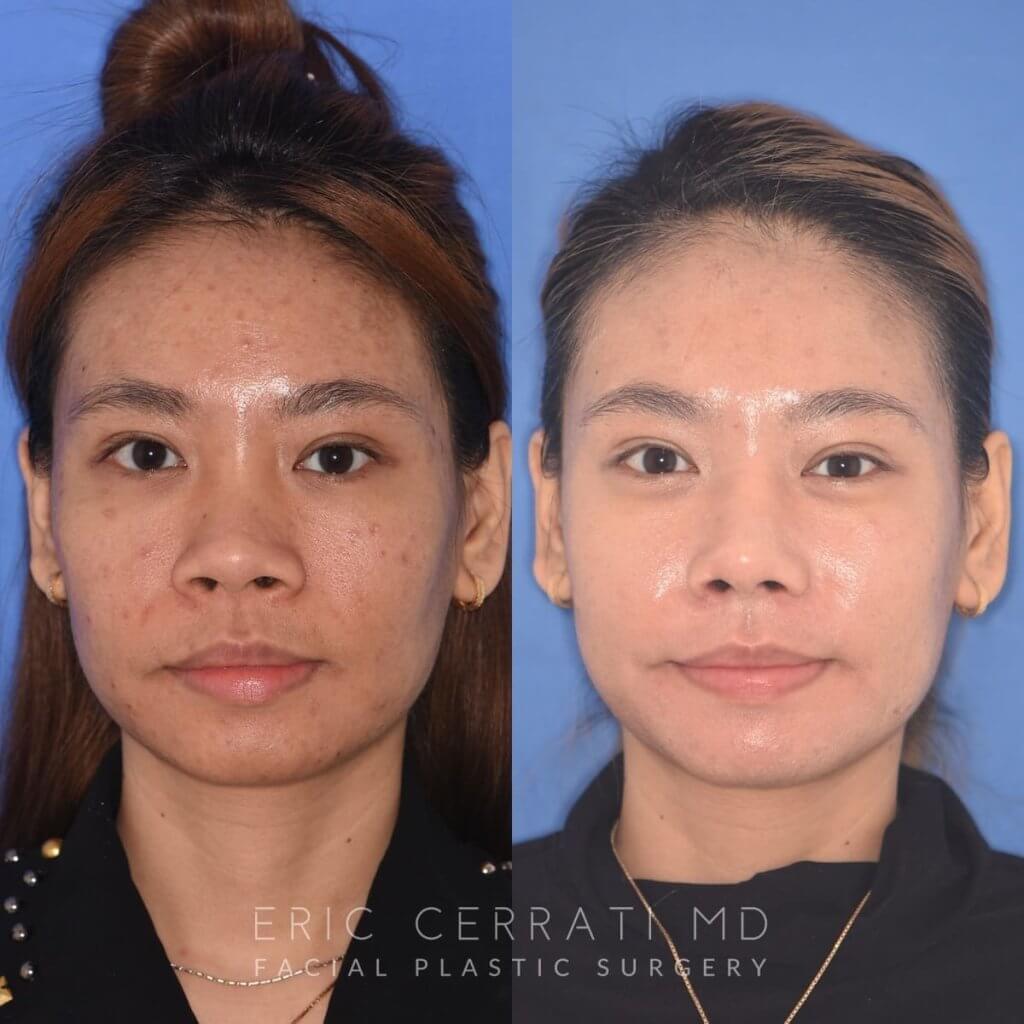 patient before and after rhinoplasty
