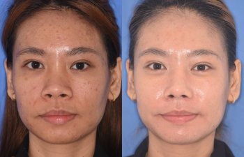 patient before and after rhinoplasty