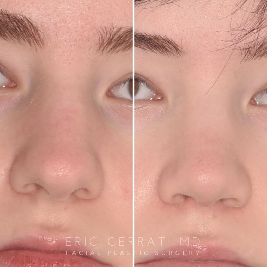 patient before and after rhinoplasty