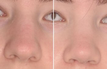 patient before and after rhinoplasty