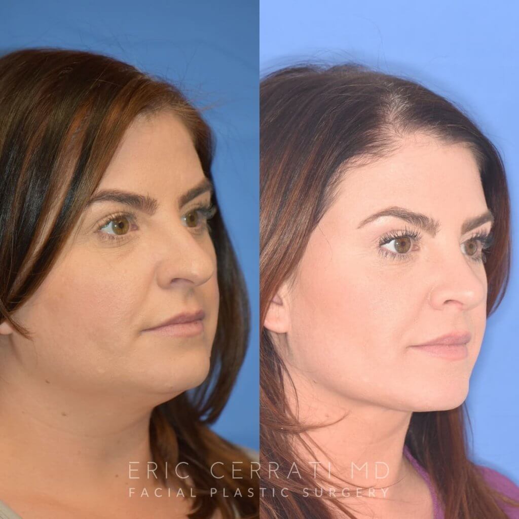 patient before and after rhinoplasty