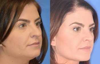patient before and after rhinoplasty