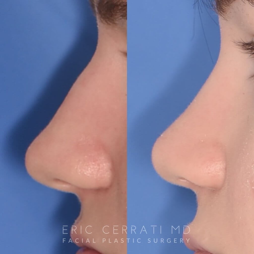 patient before and after rhinoplasty