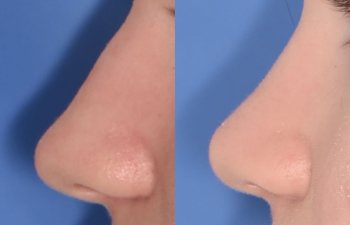 patient before and after rhinoplasty