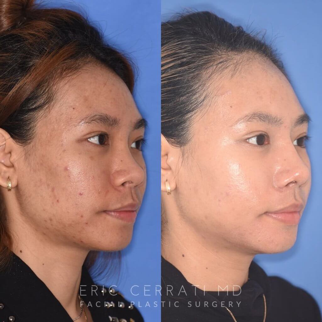 patient before and after rhinoplasty