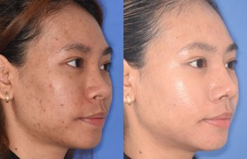 patient before and after rhinoplasty
