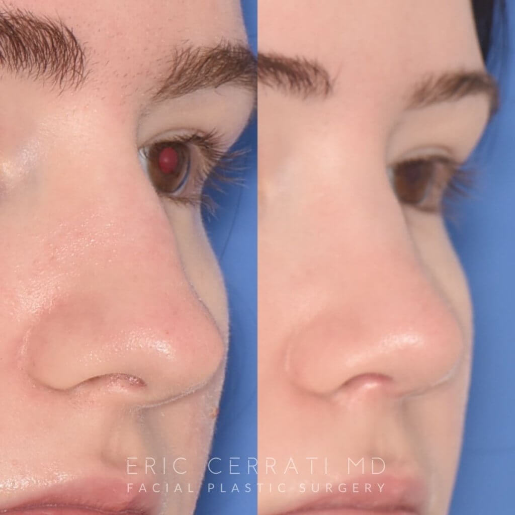 patient before and after rhinoplasty