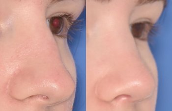 patient before and after rhinoplasty