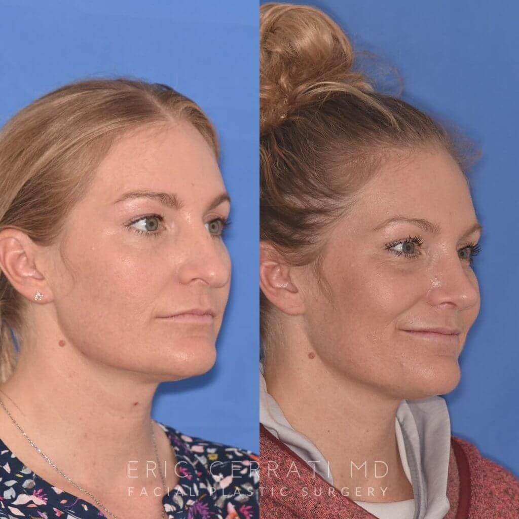 female patient before and after rhinoplasty