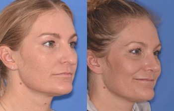 female patient before and after rhinoplasty