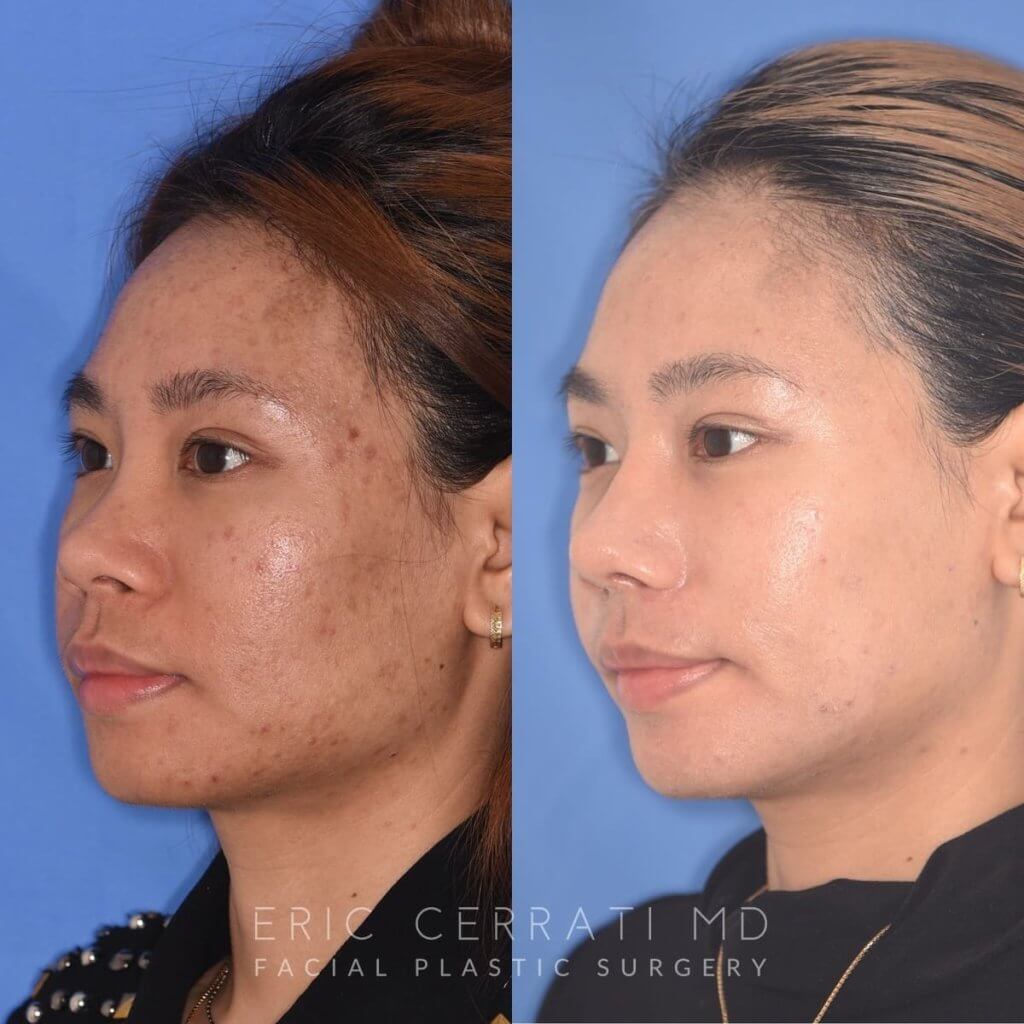 patient before and after rhinoplasty
