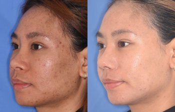 patient before and after rhinoplasty