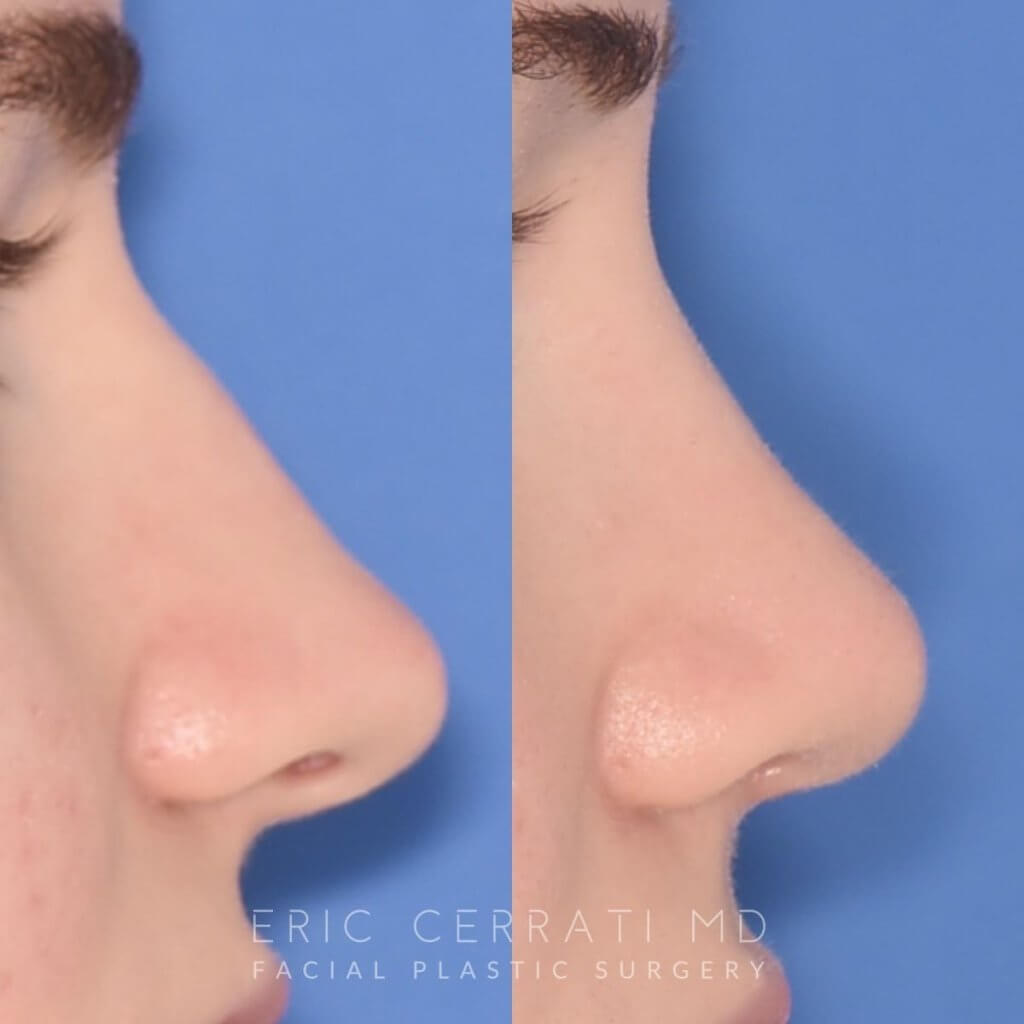 patient before and after rhinoplasty