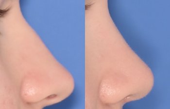 patient before and after rhinoplasty