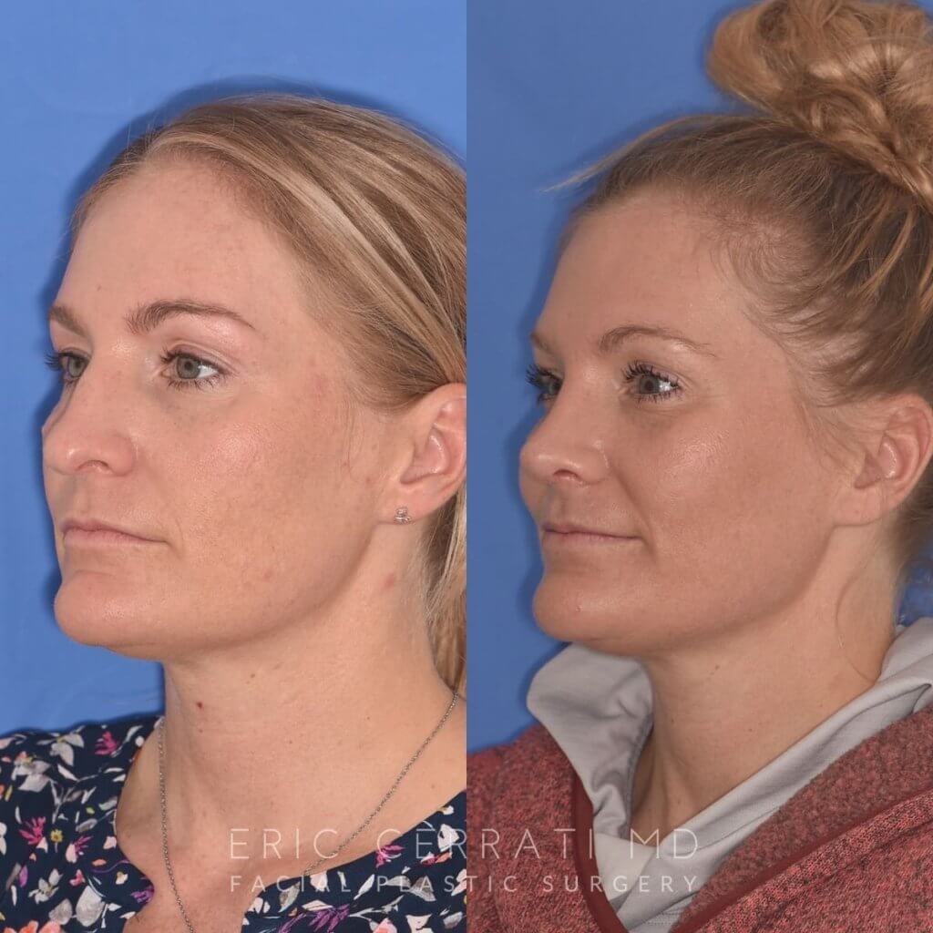 female patient before and after rhinoplasty