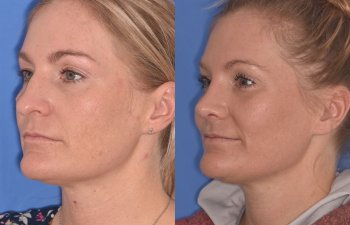 female patient before and after rhinoplasty