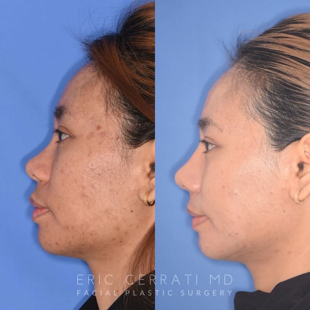 patient before and after rhinoplasty