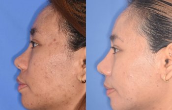 patient before and after rhinoplasty