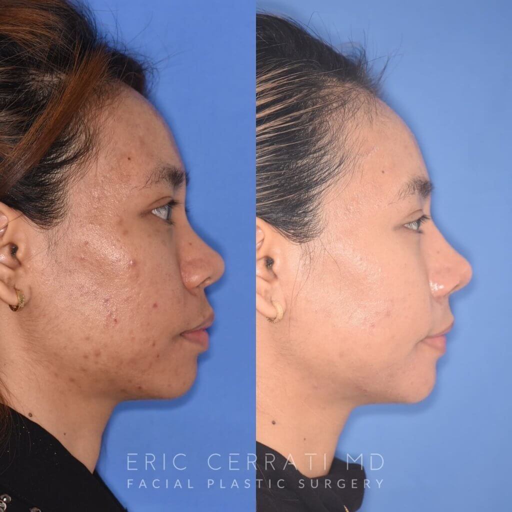 patient before and after rhinoplasty
