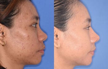 patient before and after rhinoplasty
