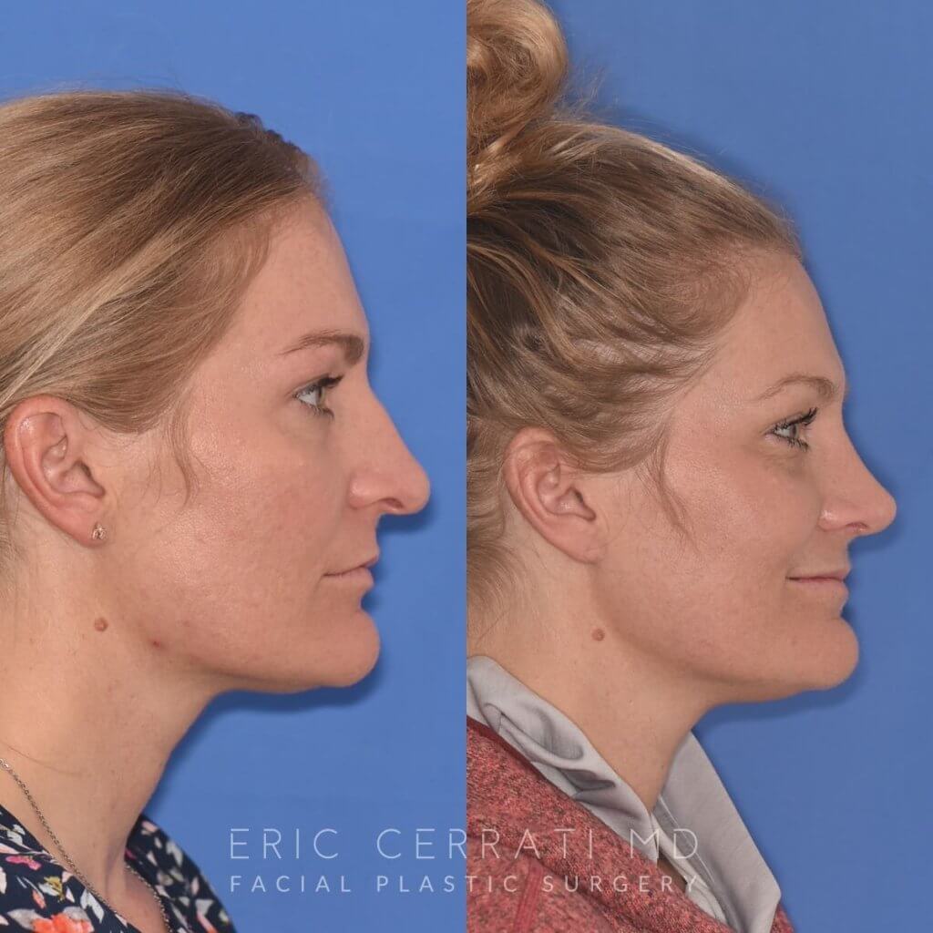 female patient before and after rhinoplasty