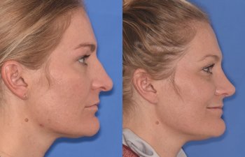 female patient before and after rhinoplasty