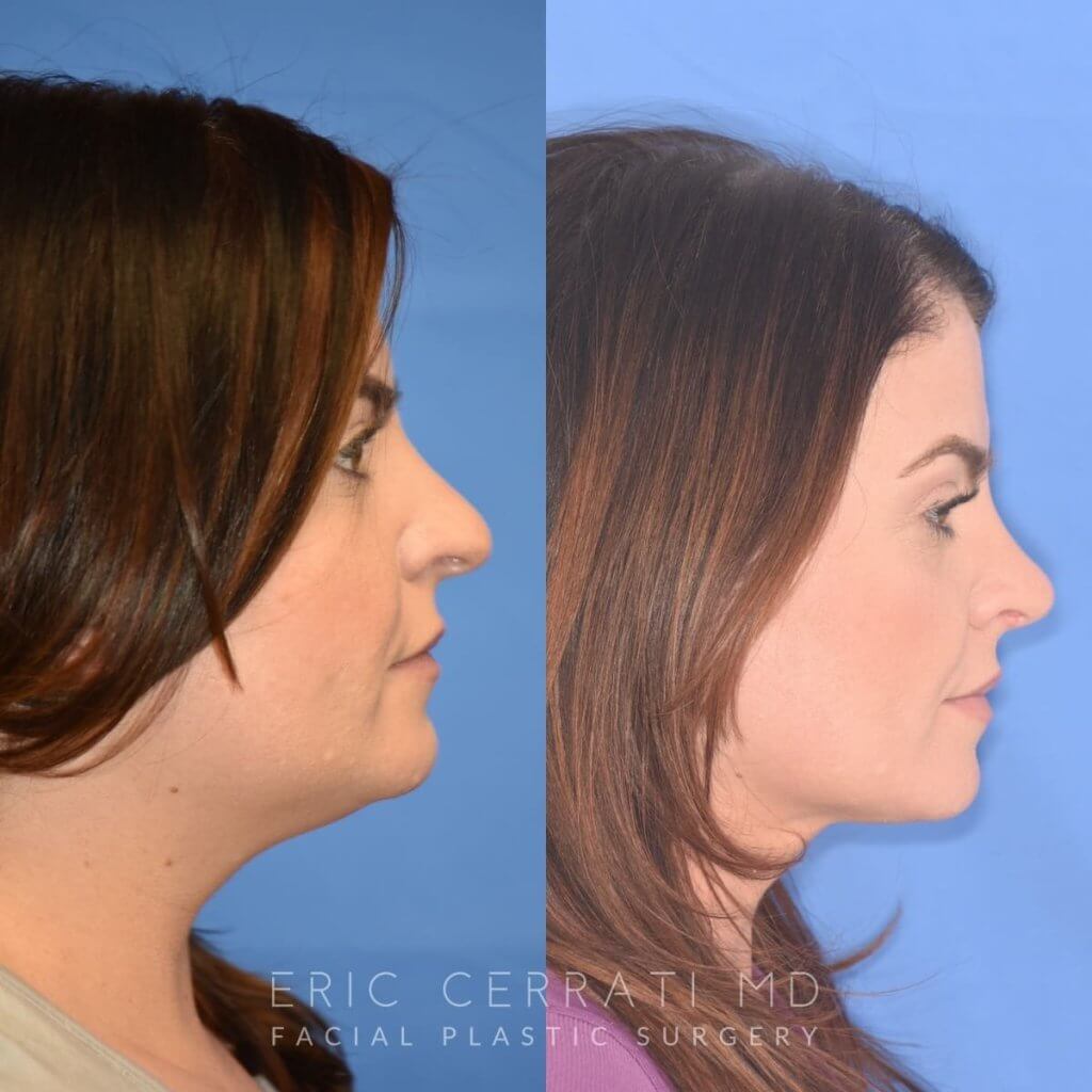 patient before and after rhinoplasty