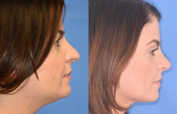 patient before and after rhinoplasty