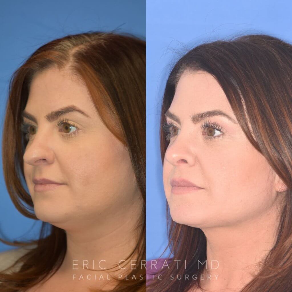 patient before and after rhinoplasty