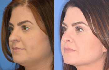 patient before and after rhinoplasty