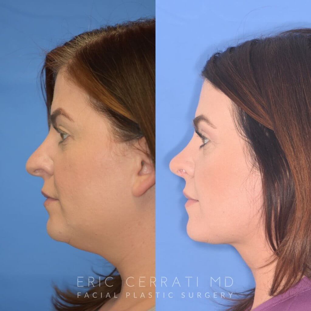 patient before and after rhinoplasty
