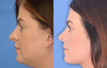 patient before and after rhinoplasty