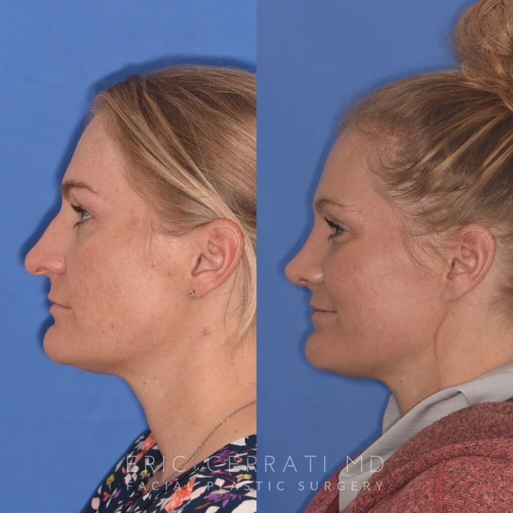female patient before and after rhinoplasty