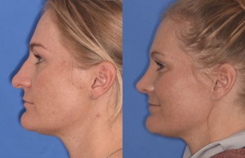 female patient before and after rhinoplasty