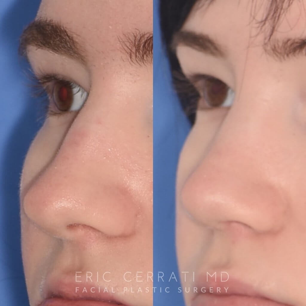 patient before and after rhinoplasty