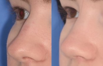 patient before and after rhinoplasty