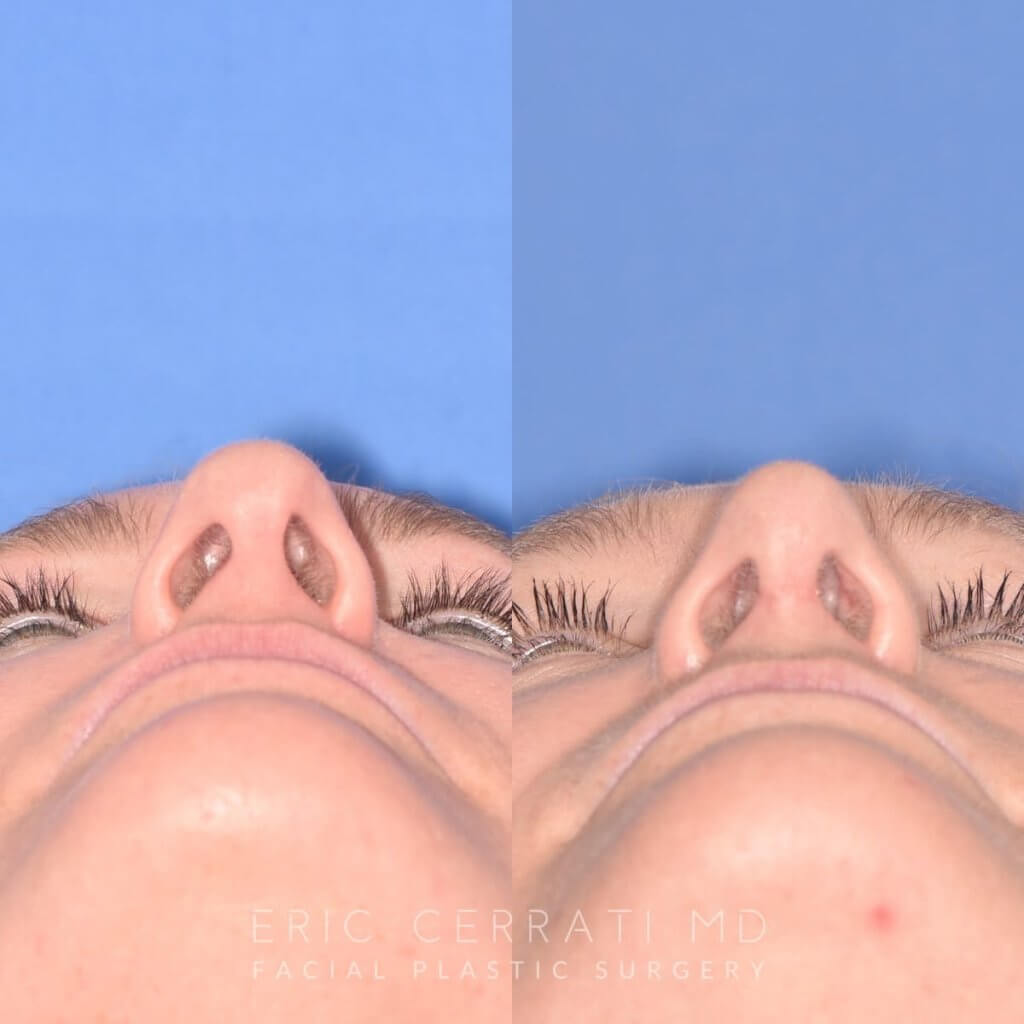 female patient before and after rhinoplasty