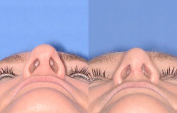 female patient before and after rhinoplasty