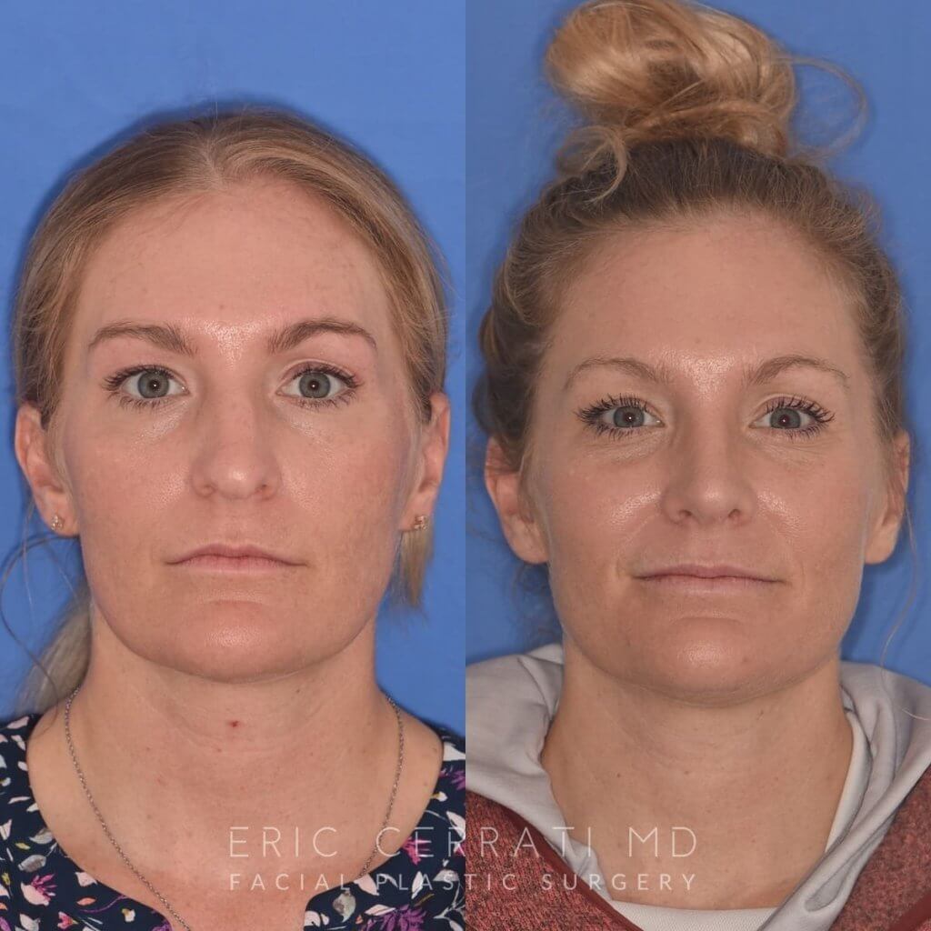 female patient before and after rhinoplasty