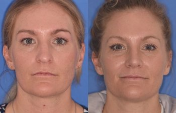 female patient before and after rhinoplasty
