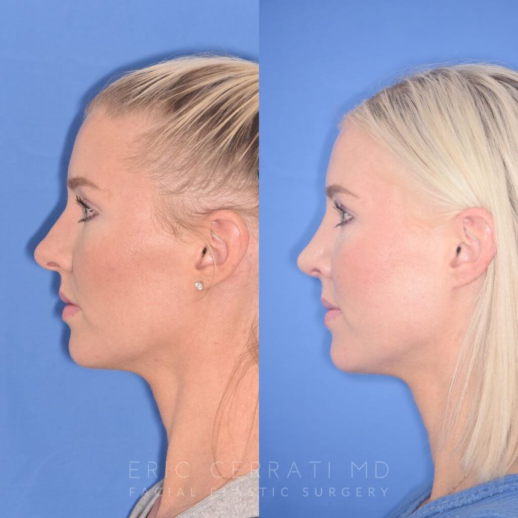 patient before and after rhinoplasty procedure