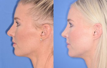 patient before and after rhinoplasty procedure