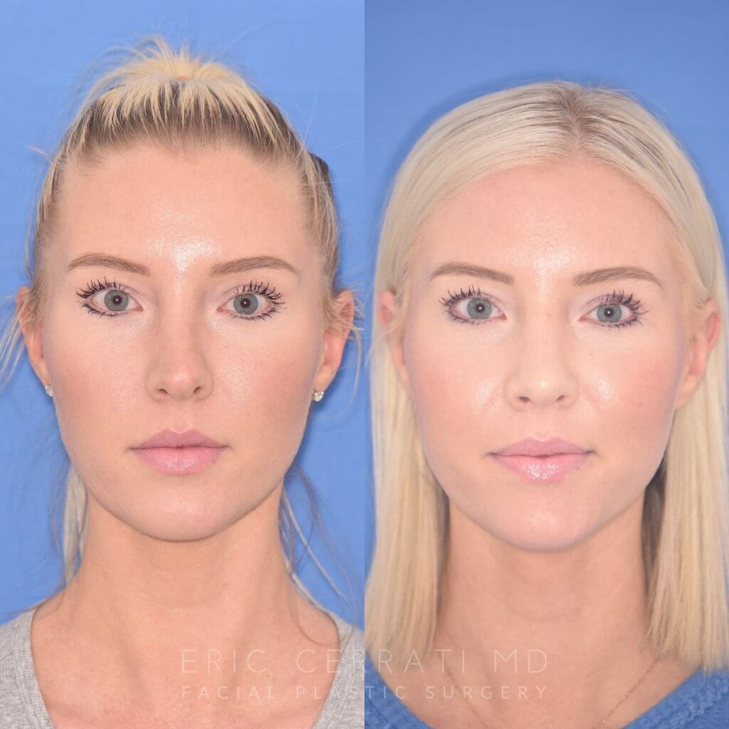 patient before and after rhinoplasty procedure